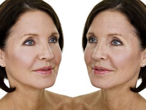 Căng da mặt nội soi giúp bạn lấy lại nét thanh xuân