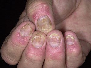 Những cách phòng bệnh nấm móng hiệu quả