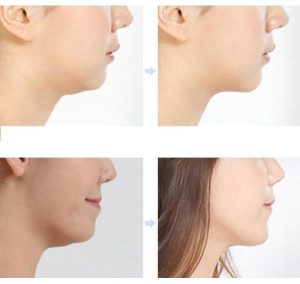 Mỡ vùng cằm cũng có thể được loại bỏ bằng công nghệ Lipo Plasma
