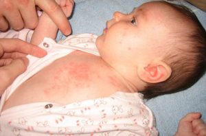 Cha mẹ phải làm gì khi con bị bệnh sốt phát ban?