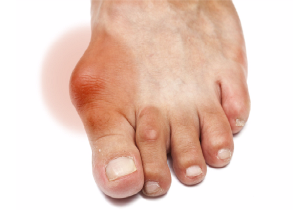 Lá tía tô được xem là thần dược điều trị bệnh gout hiệu quả